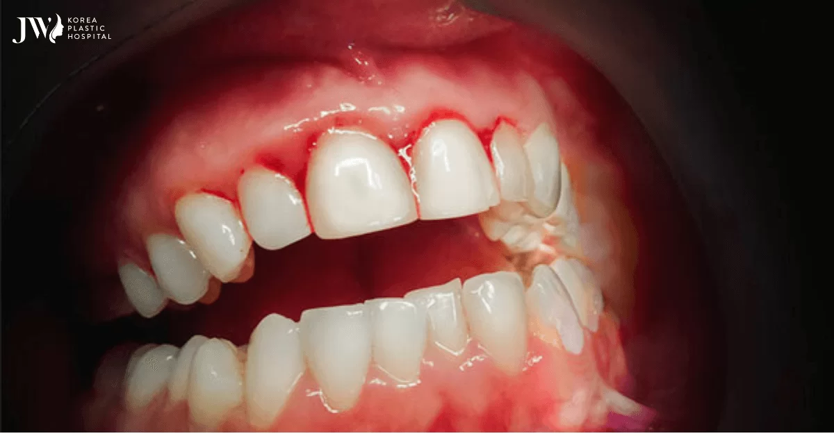 Viêm lợi có niềng răng được không?