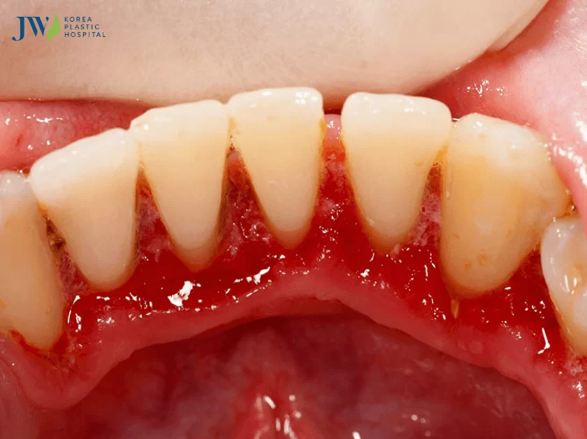 viêm lợi có niềng răng được không