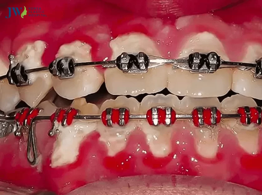 viêm lợi có niềng răng được không
