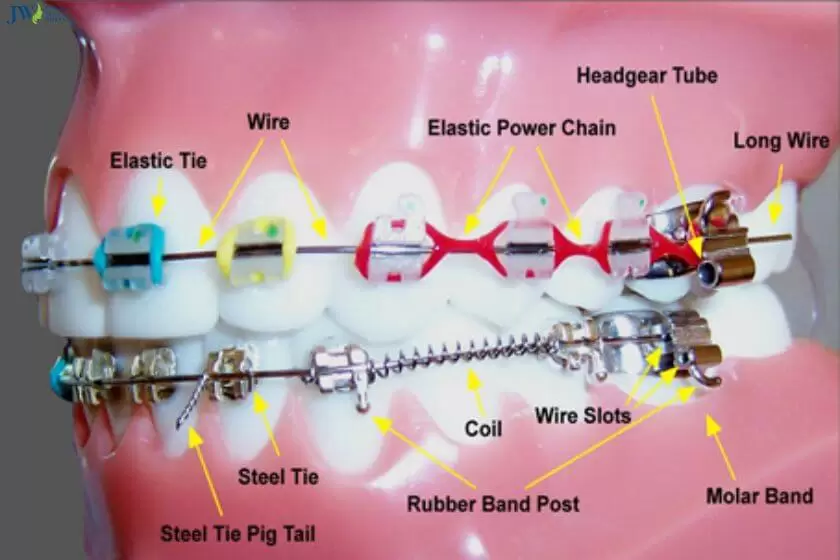 Các khí cụ niềng răng