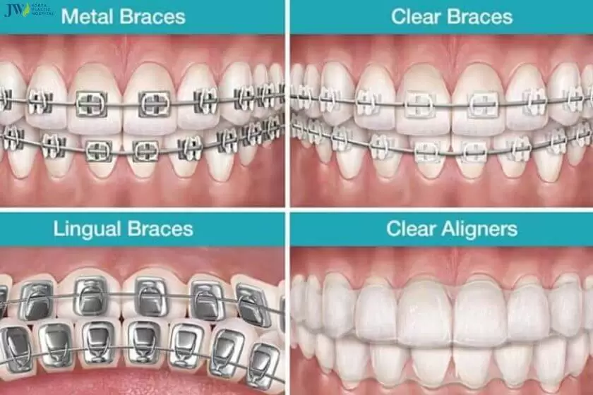 Các loại niềng răng