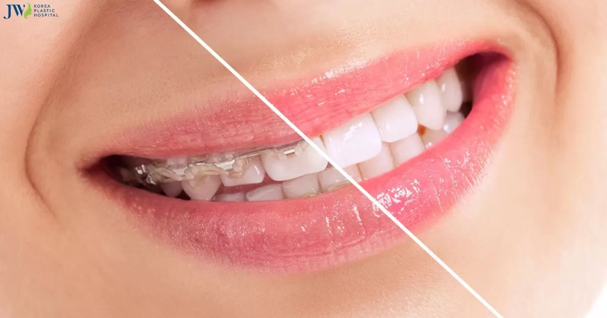 Có thể bạn chưa biết: Niềng răng làm răng yếu đi và lung lay!