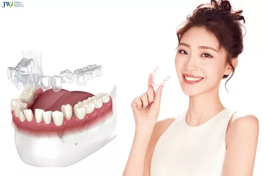 Kết quả niềng răng