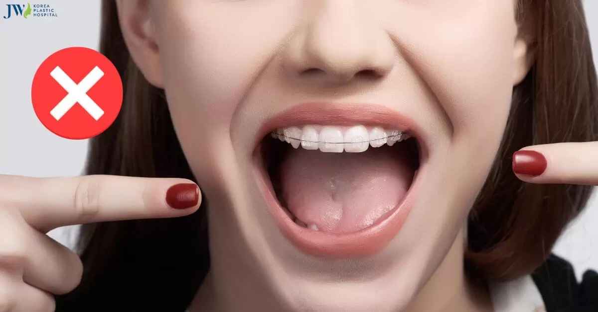Mách bạn những thói quen xấu cần tránh khi niềng răng và giải pháp!
