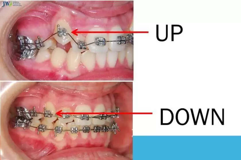 Niềng răng thay đổi vị trí răng