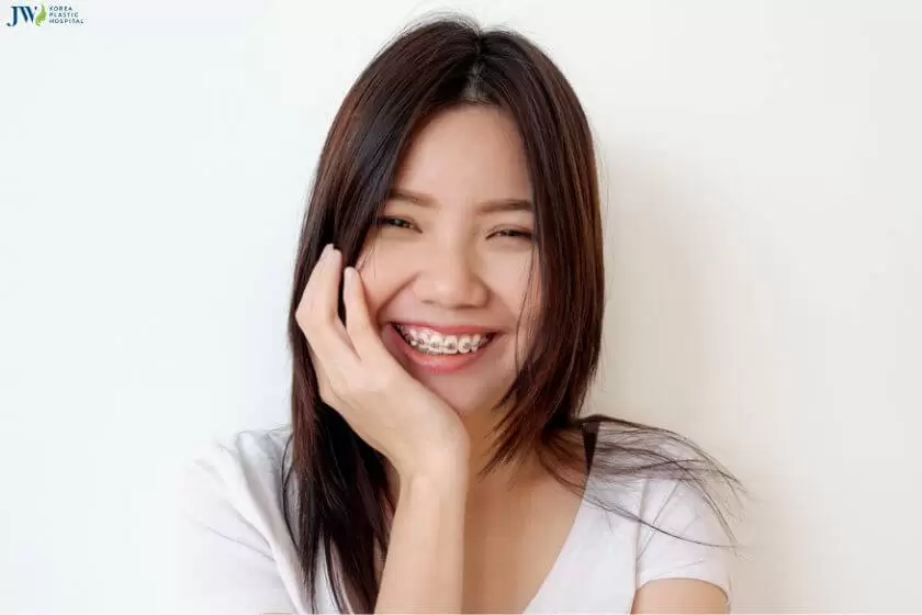 Răng có xu hướng chạy lại sau khi tháo niềng