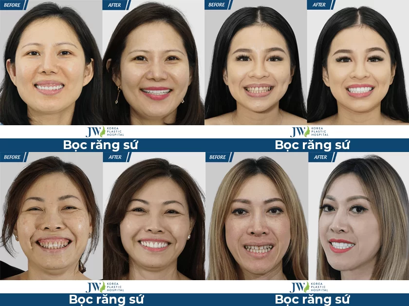 Bọc răng sứ