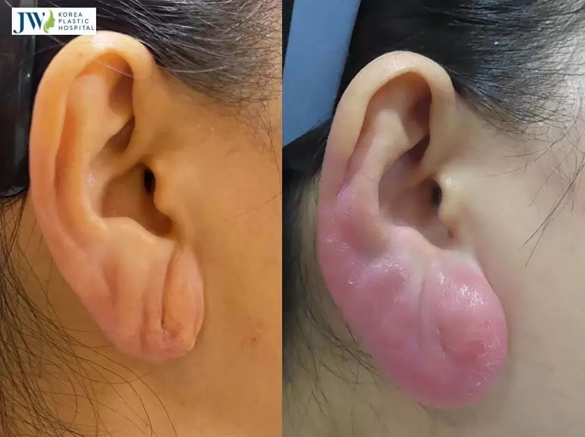 tiêm silicone