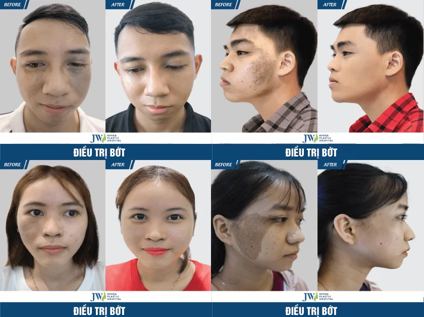 dieu-tri-bot-ban-sinh-voi-cong-nghe-3s-plus-hien-dai