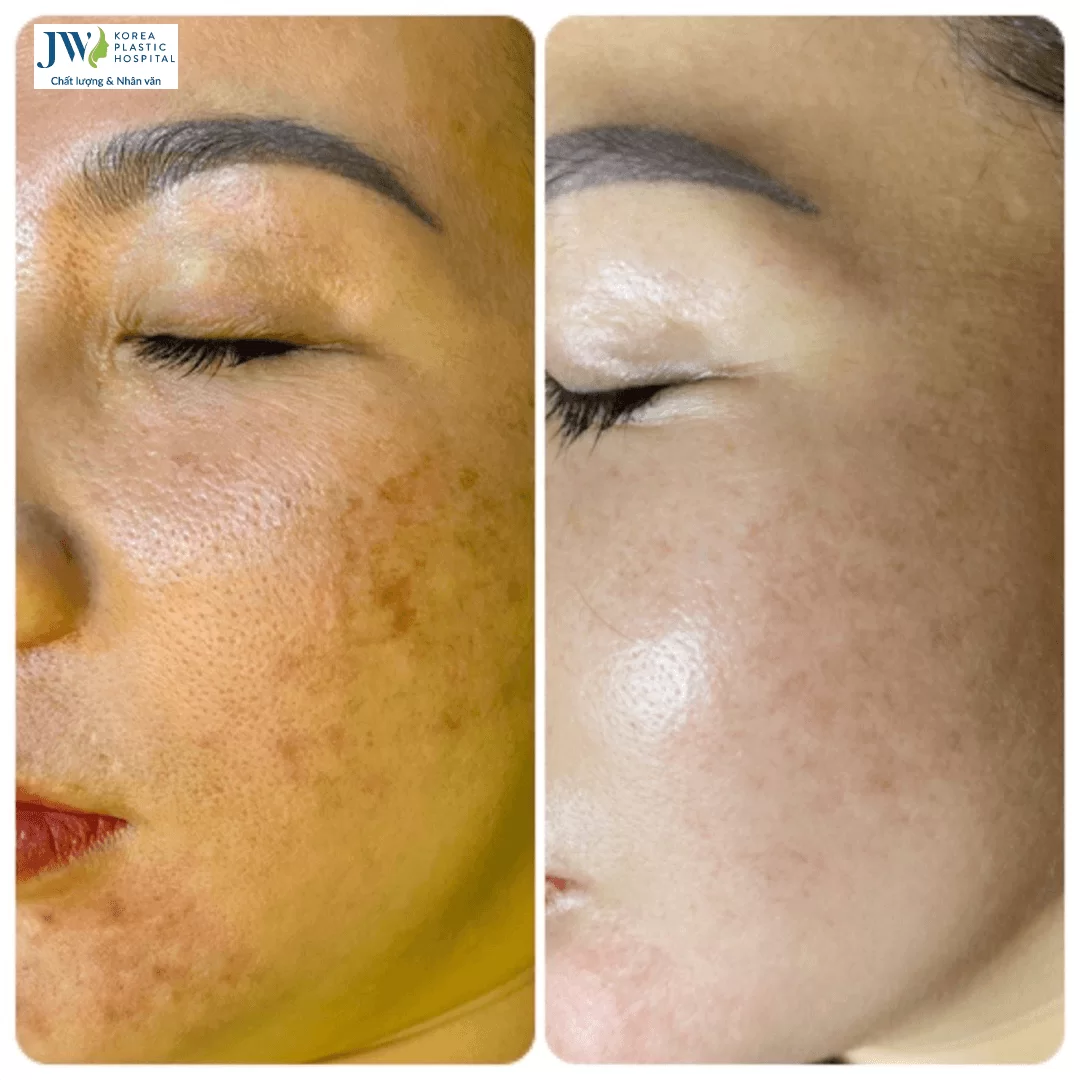 Công nghệ 3S Plus điều trị nám