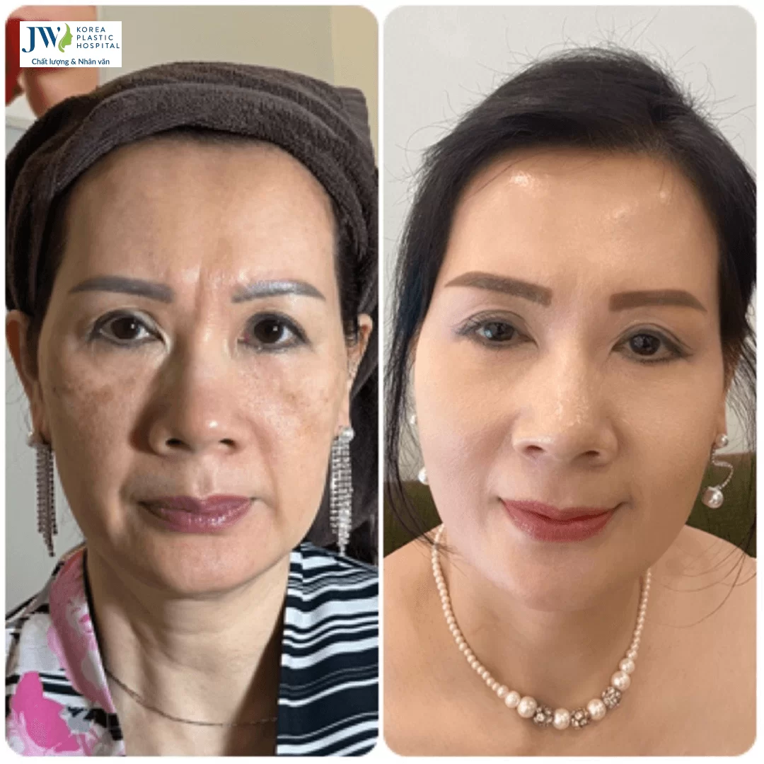 Công nghệ 3S Plus điều trị nám
