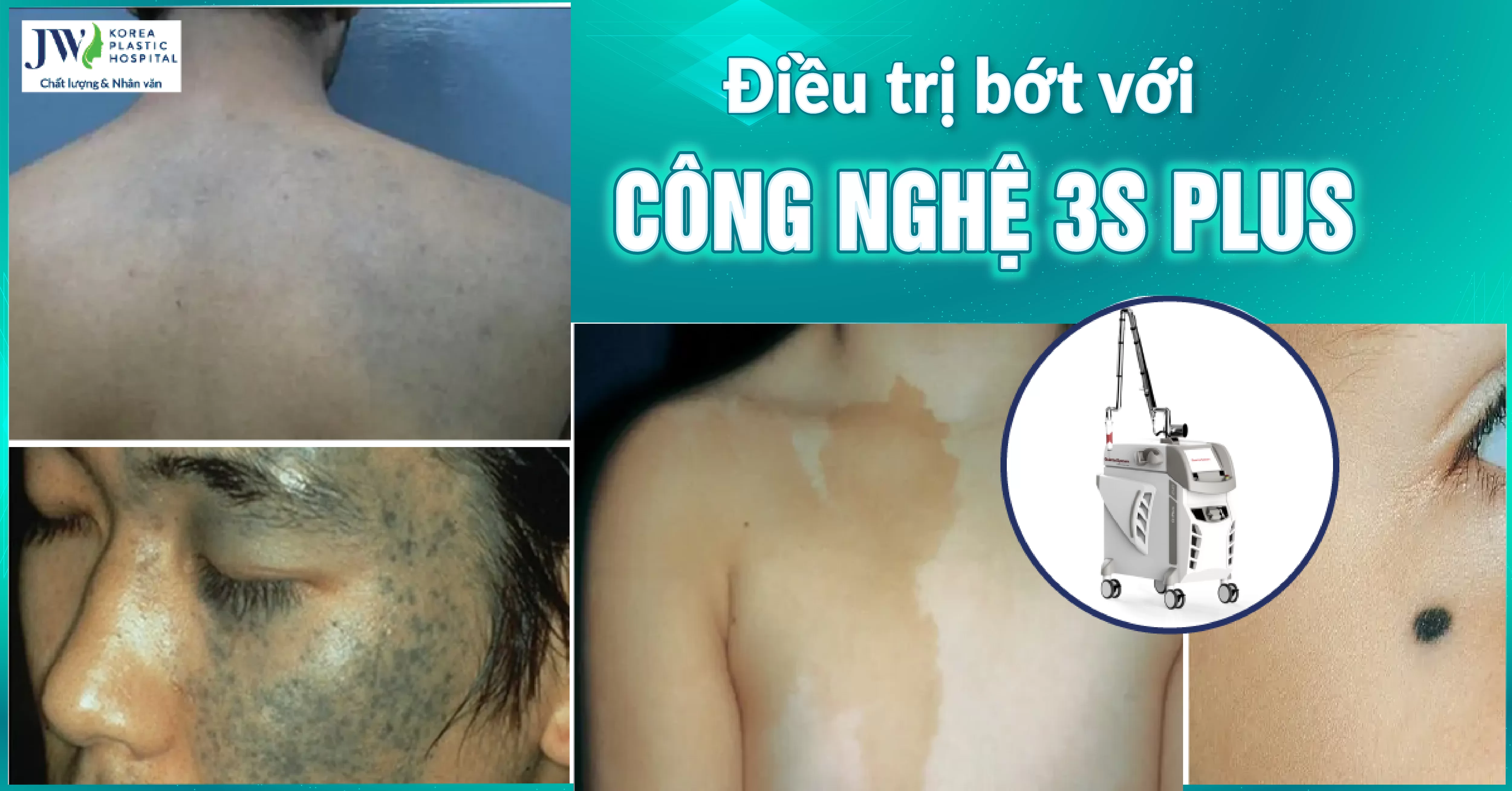 Điều trị bớt bẩm sinh với công nghệ 3S PLUS hiện đại