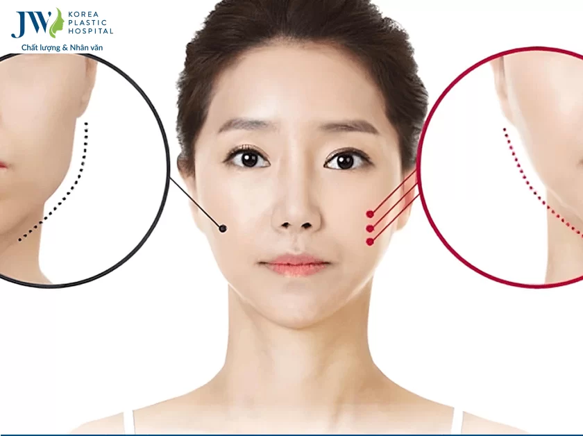 Mặt V Line
