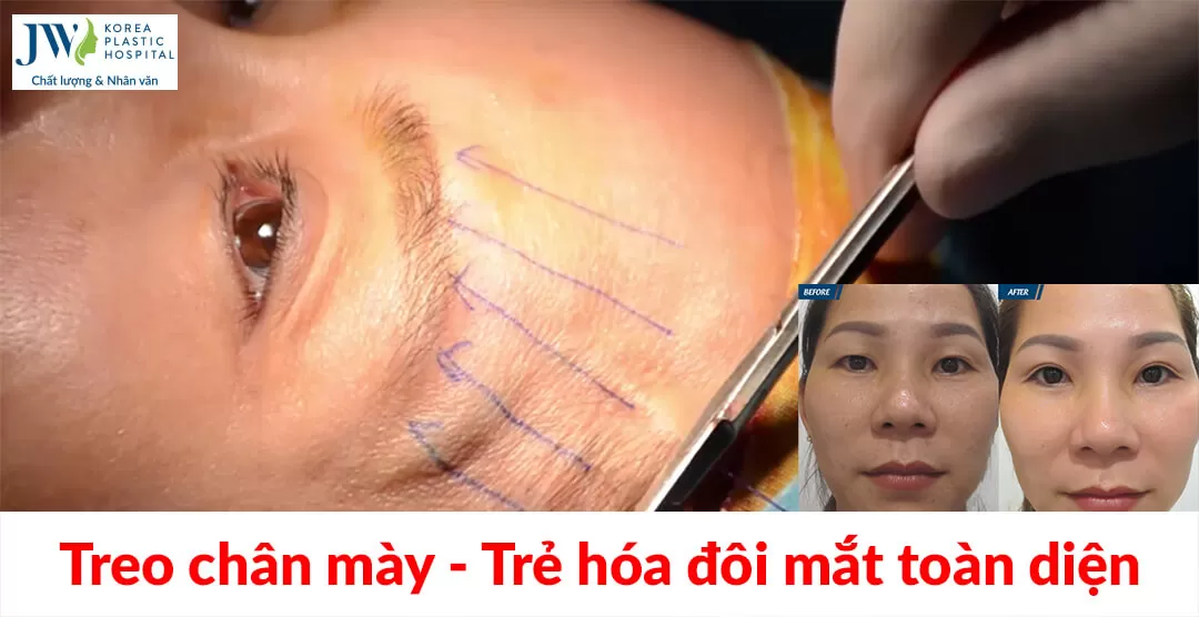 Treo chân mày: Trẻ hóa đôi mắt toàn diện chỉ với 45 phút 