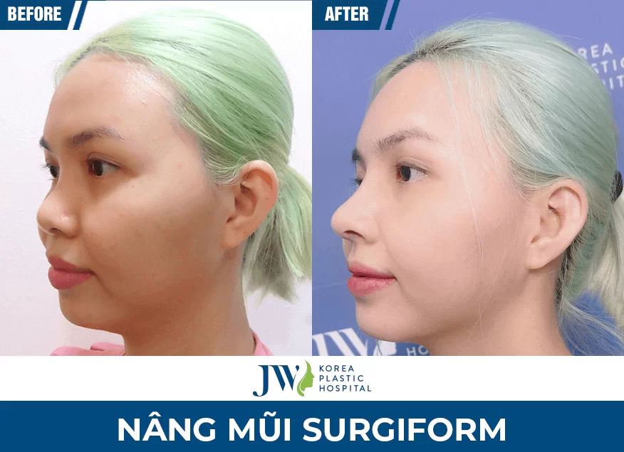 Nâng mũi surgiform