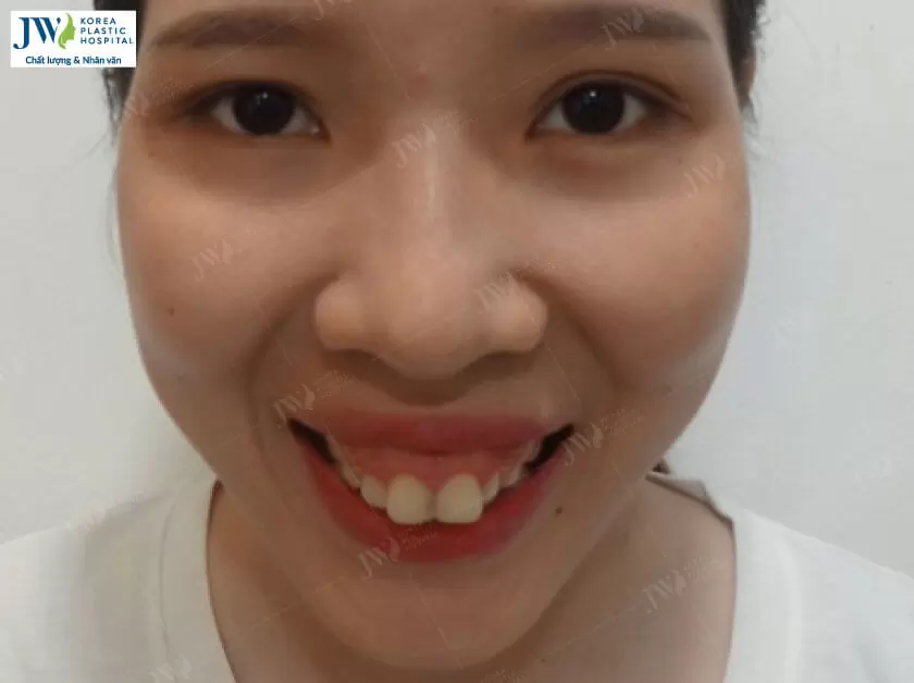 phẫu thuật hàm hô