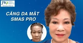 căng da mặt smas pro