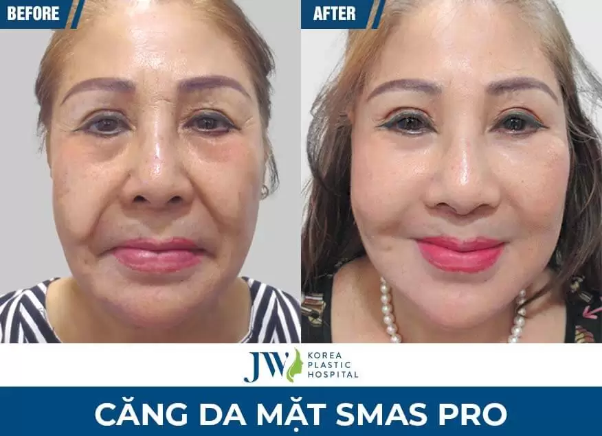 cang-da-mat-smas-pro-jw