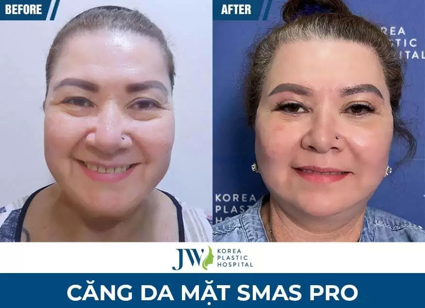 dich-vu-cang-da-mat-smas-pro-jw