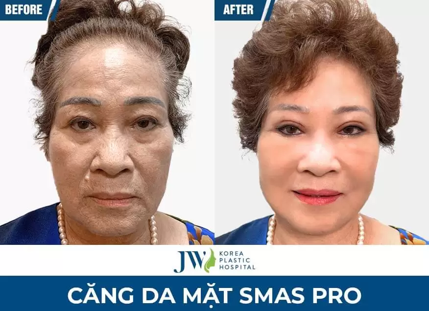 ky-thuat-cang-da-mat-smas-pro-jw