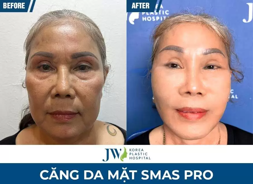 phuong-phap-cang-da-mat-smas-pro-jw
