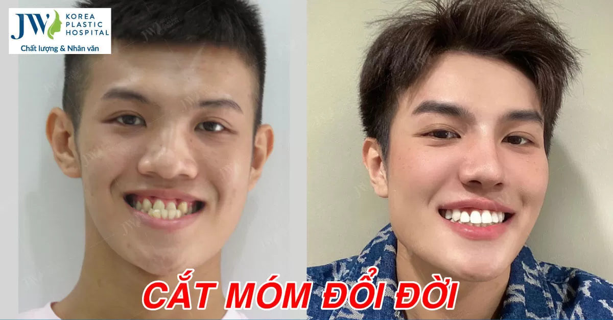 Hot Boy Cắt Hàm Móm – Đổi Đời Sự Nghiệp Thăng Hạng