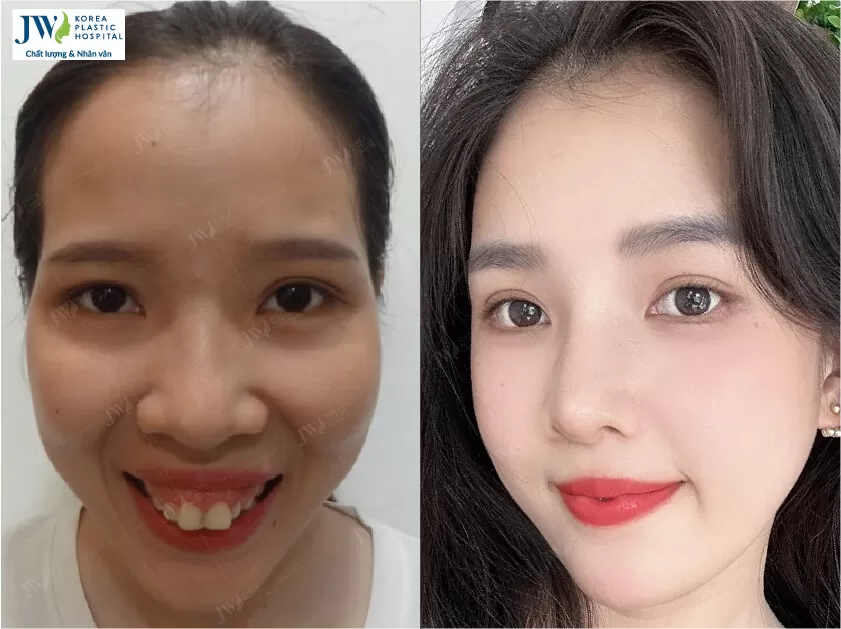 Phẫu thuật thẩm mỹ