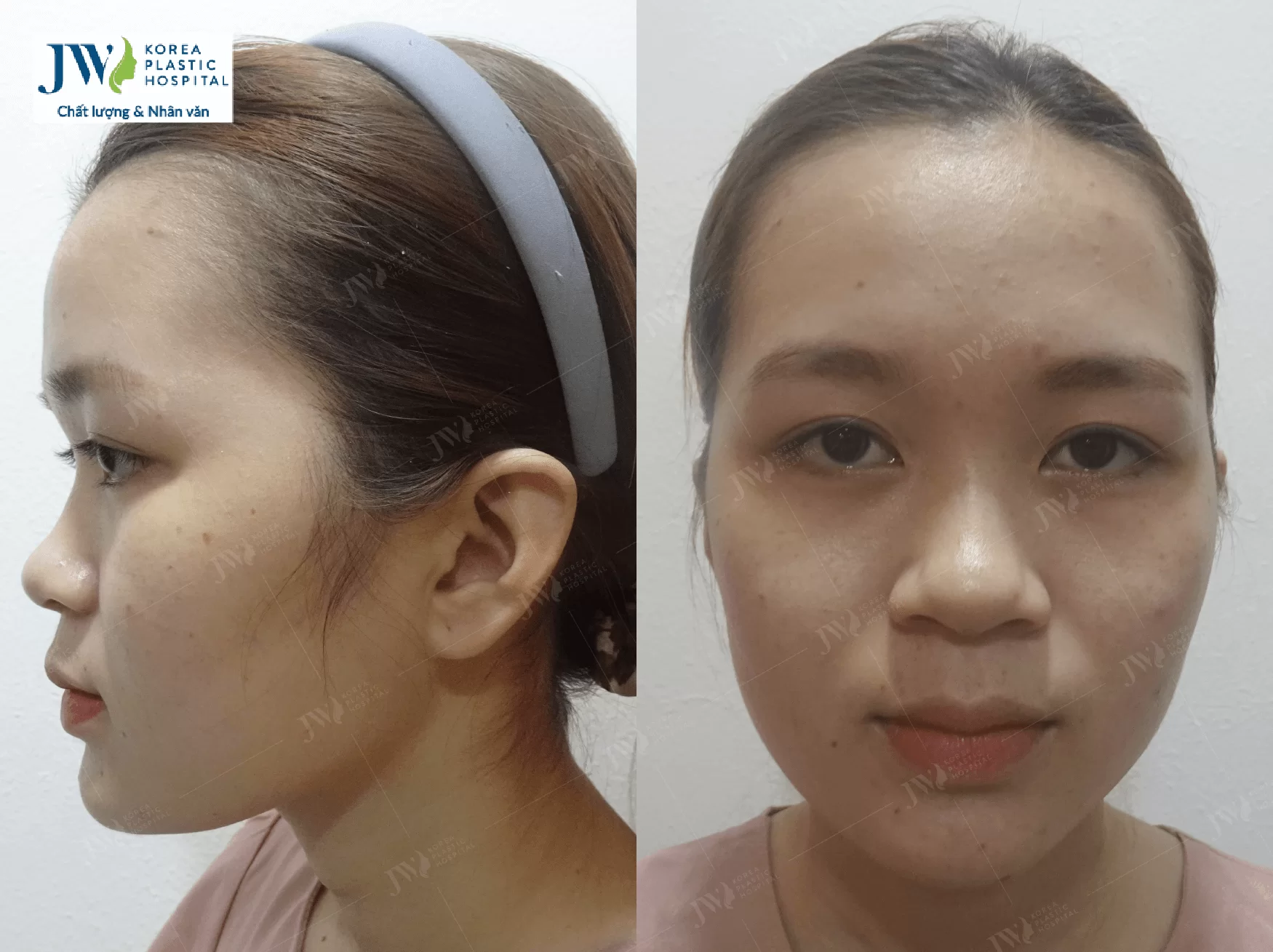 phẫu thuật thẩm mỹ