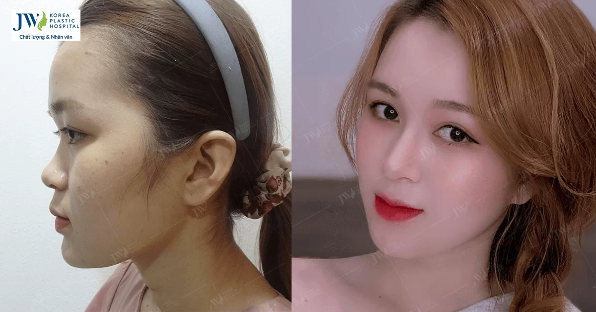 Phẫu thuật thẩm mỹ giúp cô nàng xinh đẹp tựa tiên nữ