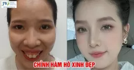 phẫu thuật hàm hô