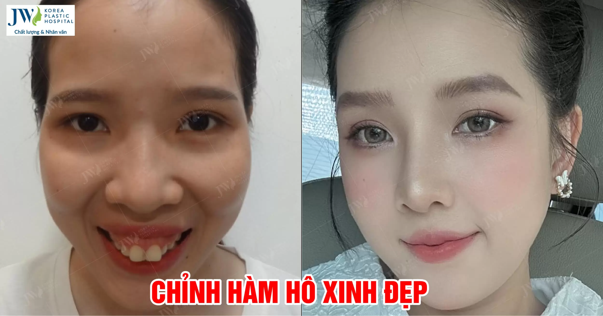 Cô nàng 9X phẫu thuật hàm hô trùng tu nhan sắc đỉnh cao