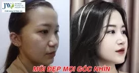 Thiên Kim nâng mũi
