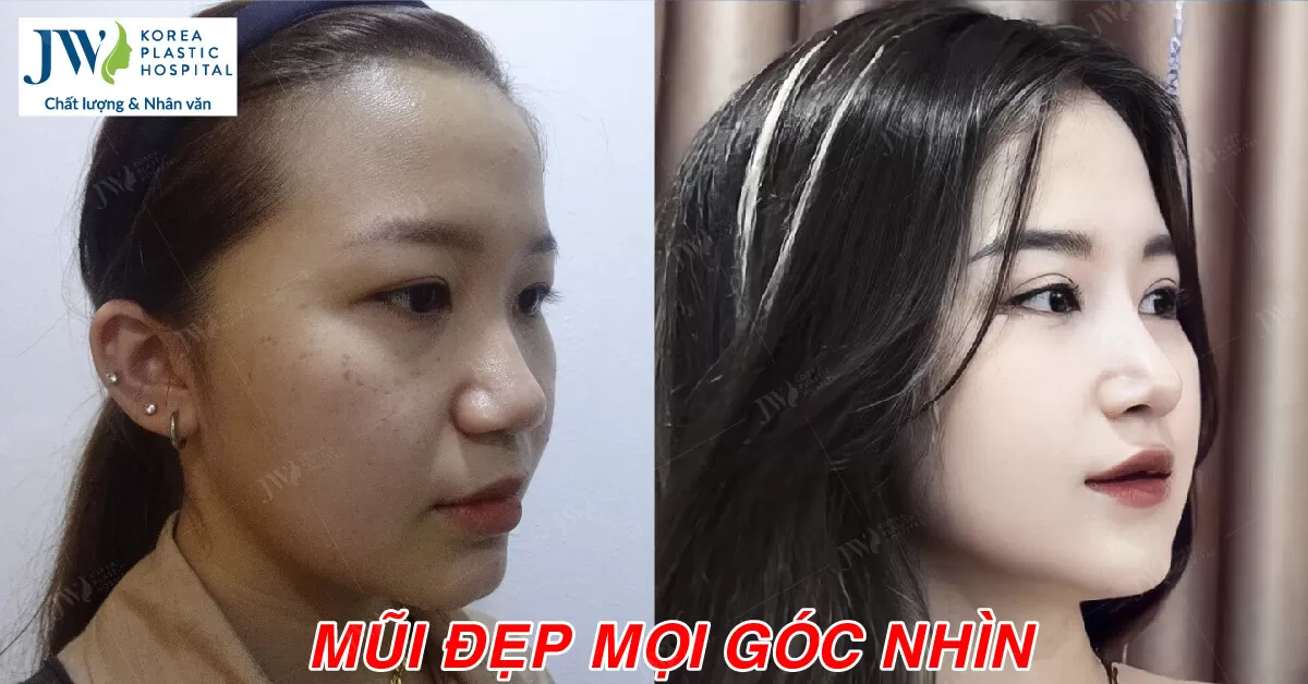 Cắt mí nâng mũi biến nữ sinh Gen Z thành nàng thơ