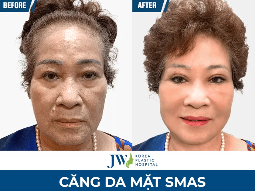 căng da mặt 