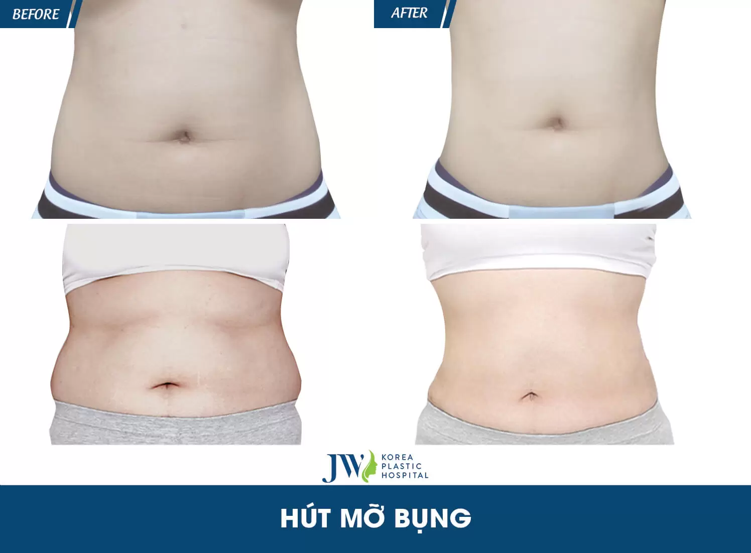 hút mỡ bụng 