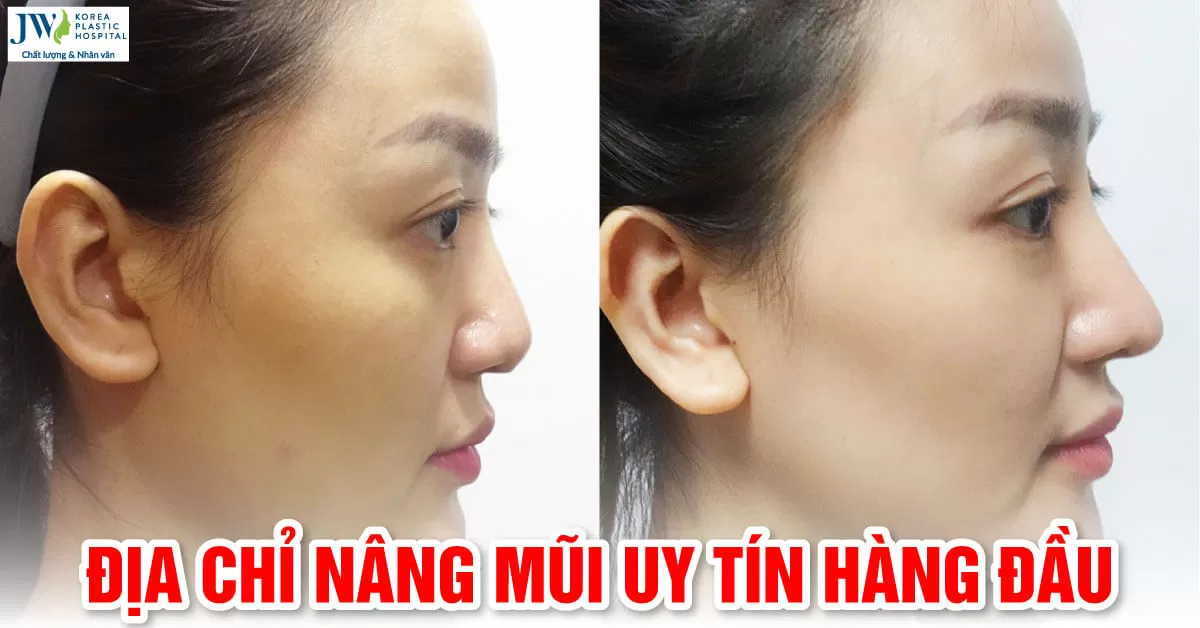 Nâng mũi để đón tết: lựa chọn thông minh hay quyết định nguy hiểm?
