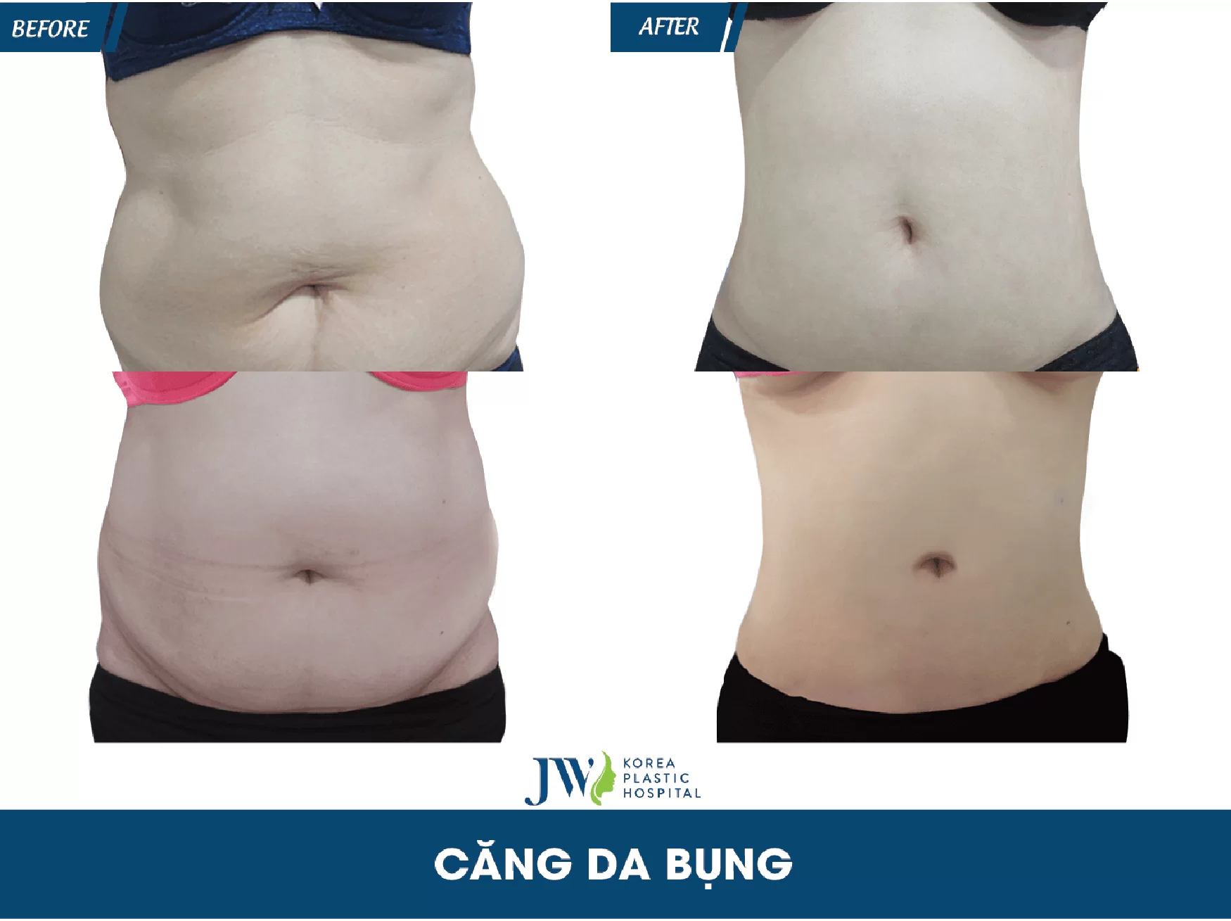 hút mỡ bụng