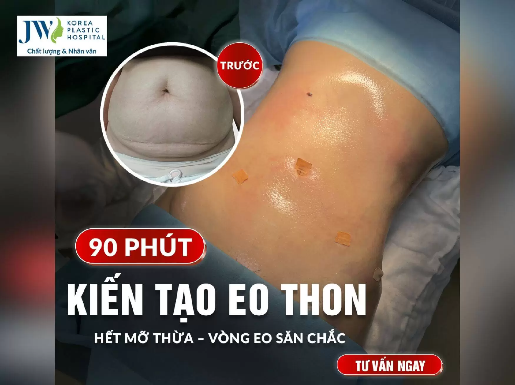 Hút mỡ bụng 
