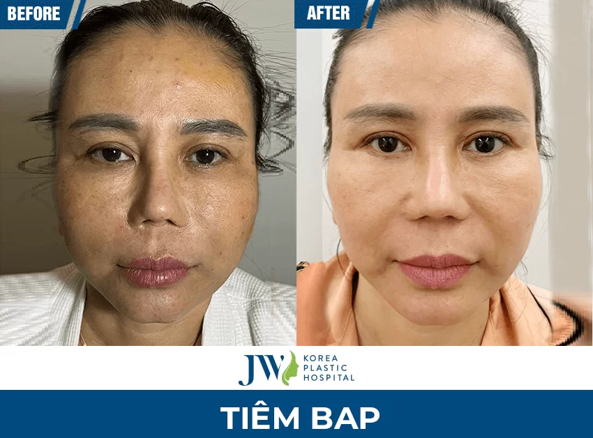 tiêm BAP