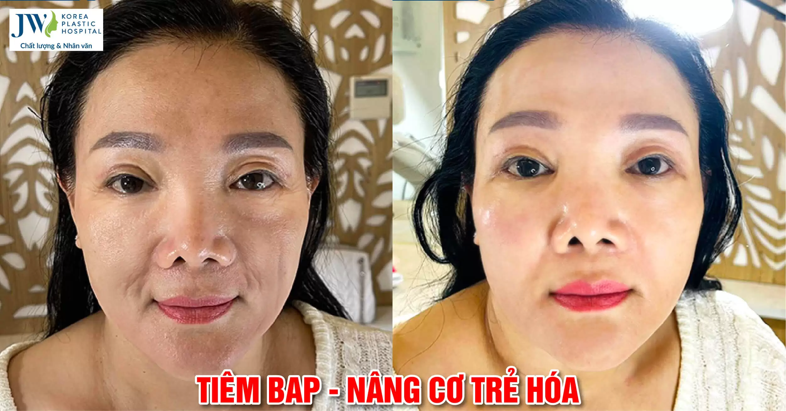 Vì sao Trẻ hóa căng bóng Profhilo được nhiều người lựa chọn?