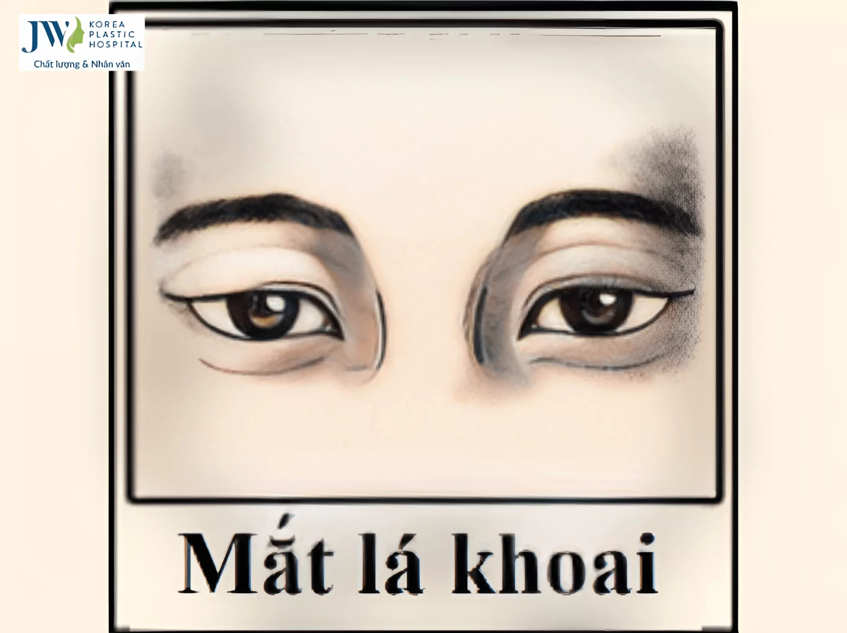 dac-diem-cua-mat-la-khoai