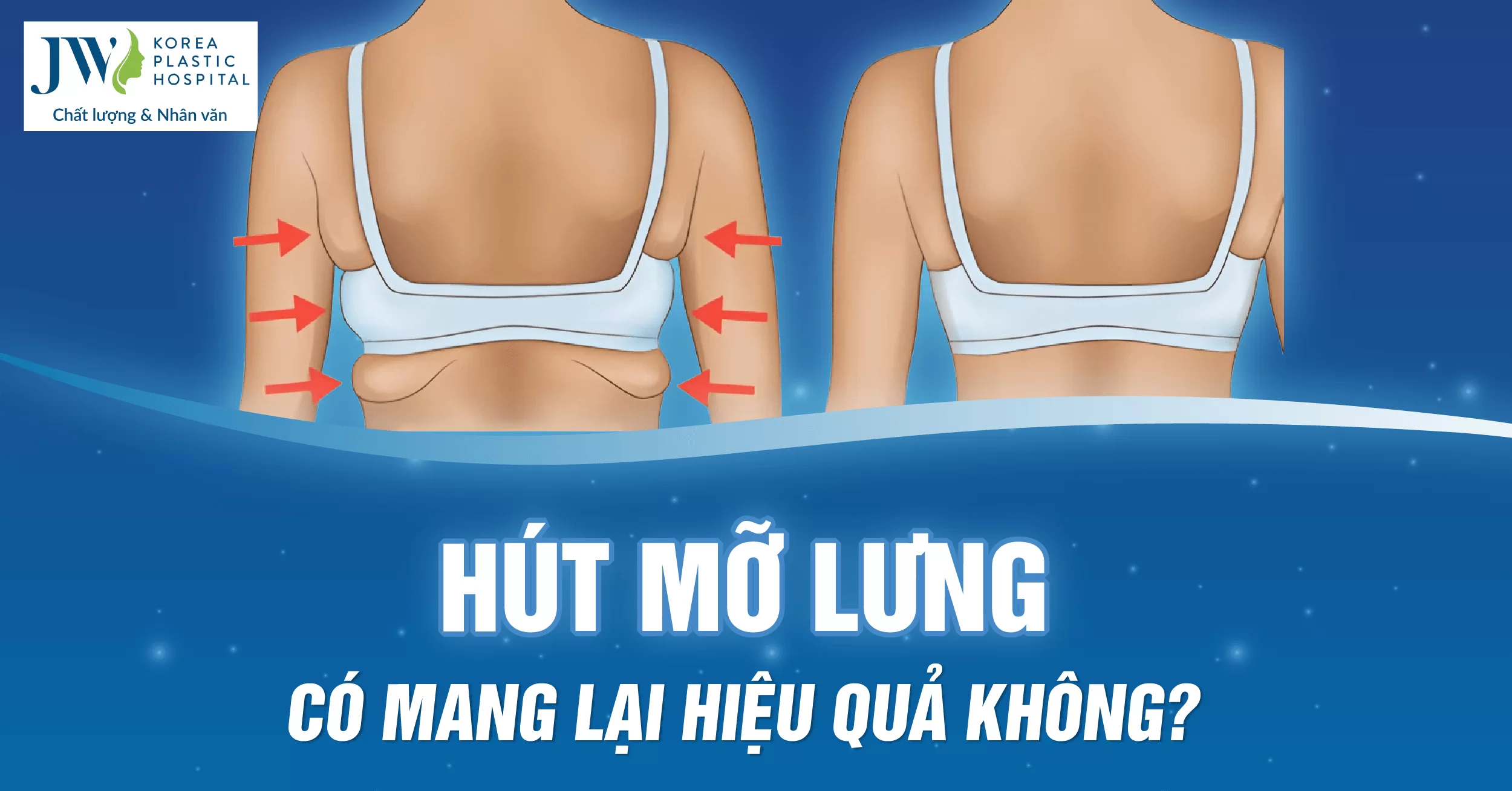 Hút mỡ lưng có thực sự hiệu quả như lời đồn? Phương pháp hút mỡ Smart Lipo hiện đại