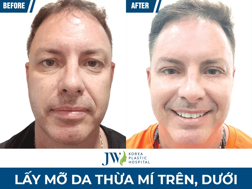 qua-sau-phau-thuat-mat-tai-jw
