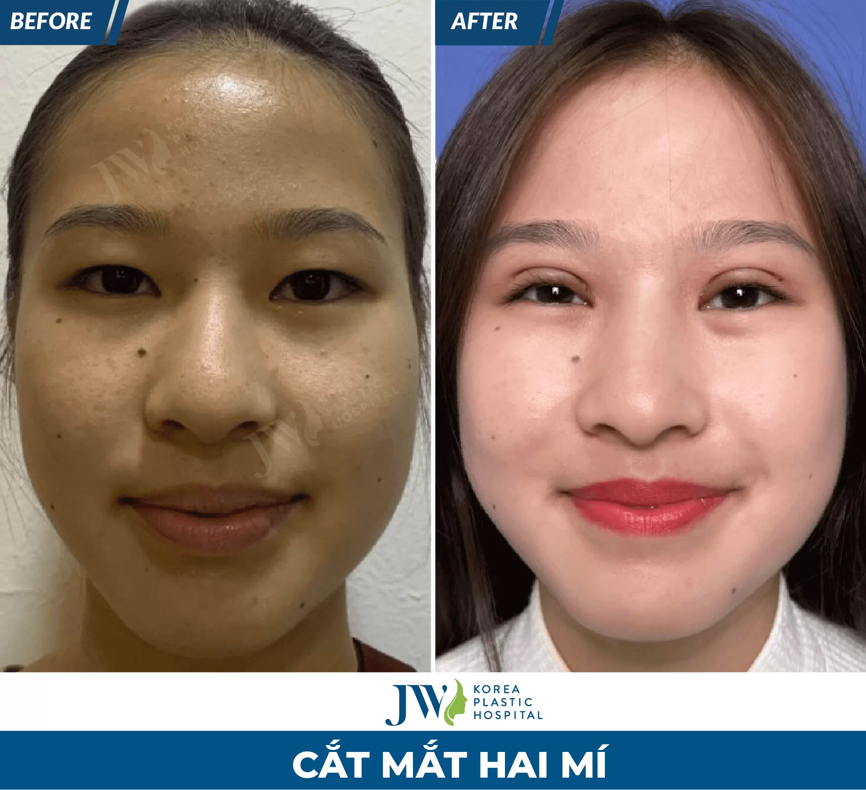 cắt mắt 2 mí
