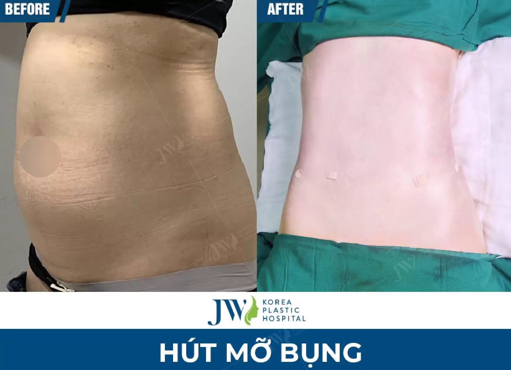 hút mỡ bụng