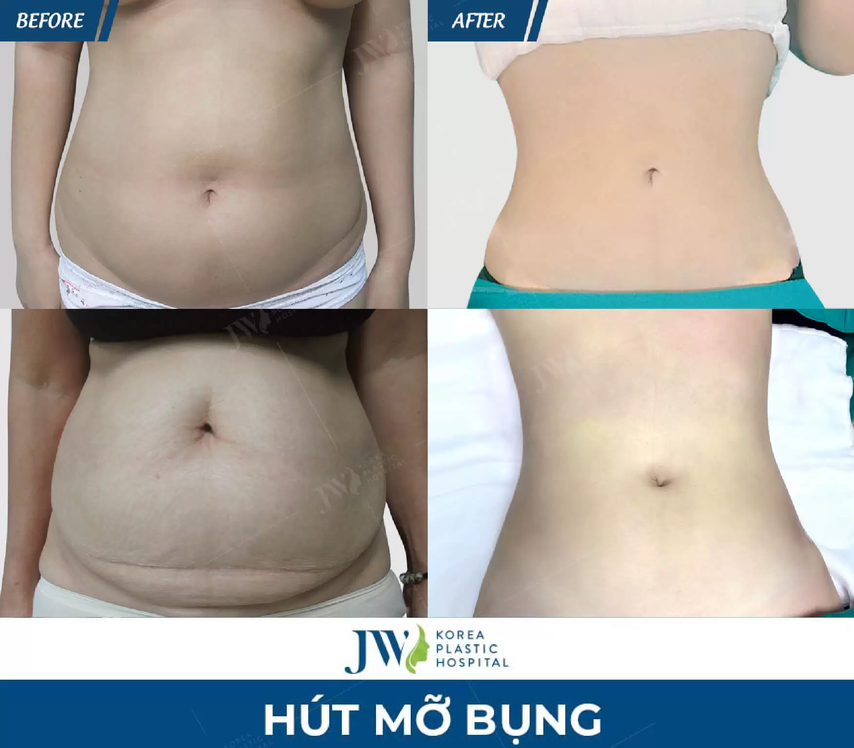 hút mỡ bụng