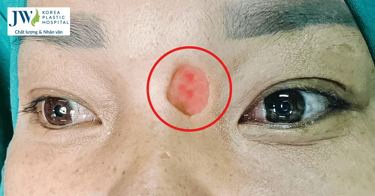 30 Năm Thủng Trán Sát Xương Sọ, Người Phụ Nữ Được Phẫu Thuật Thành Công