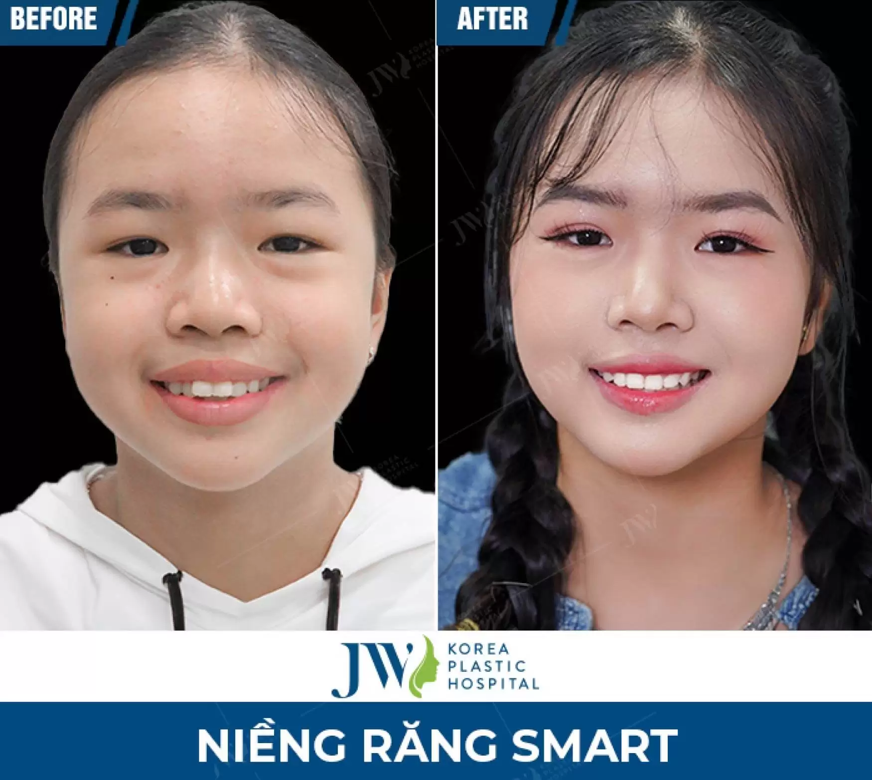 nieng rang smart
