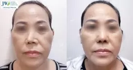 nâng mũi sụn sườn