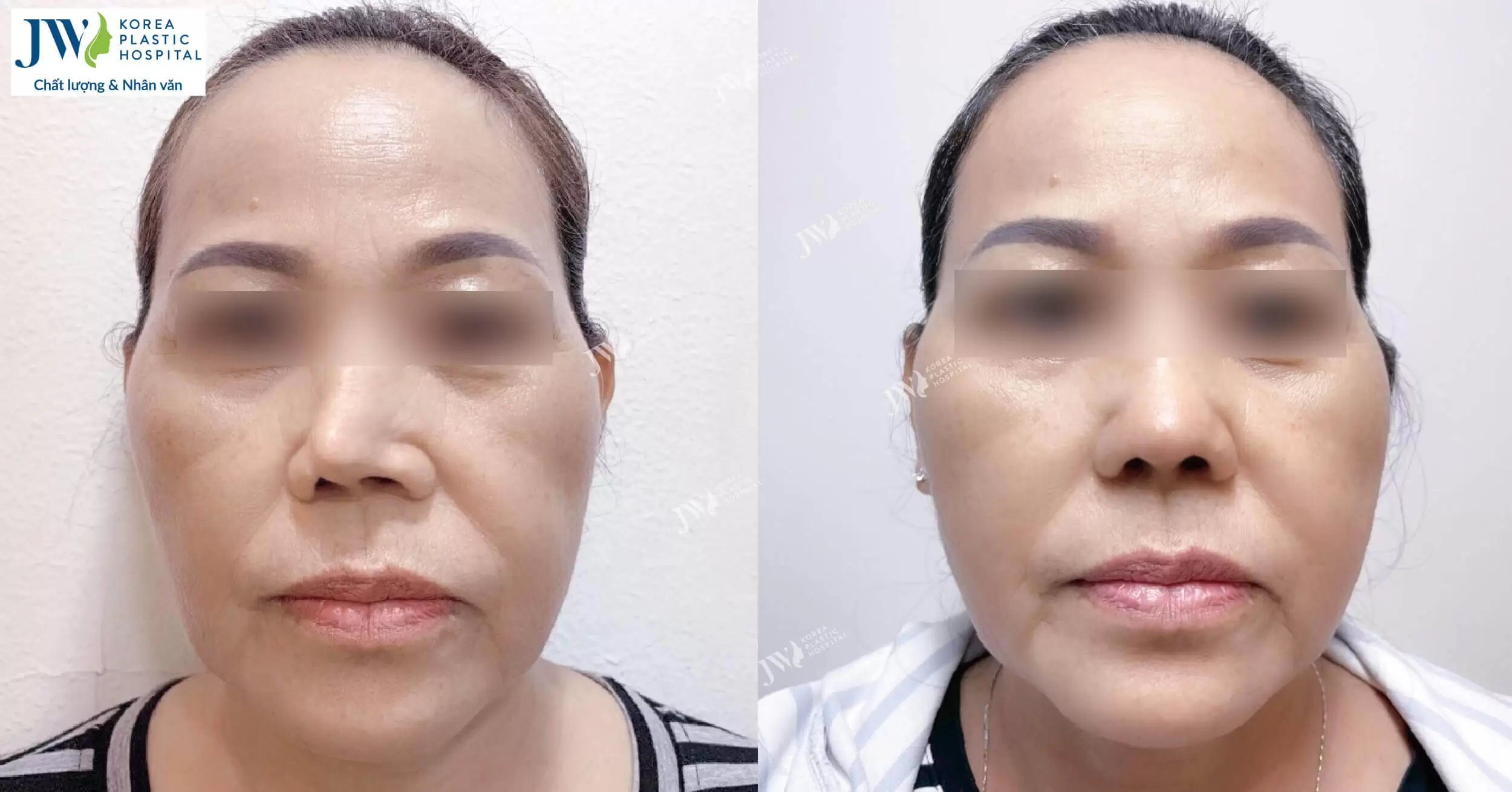 Nâng mũi sụn sườn: Giải cứu mũi co rút cho quý cô Việt Kiều